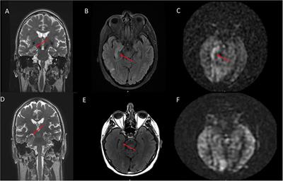 Arterial Spin Labeling Imaging Characteristics of Anti-leucine-rich Glioma-Inactivated 1 Encephalitis: A Qualitative and Quantitative Analysis